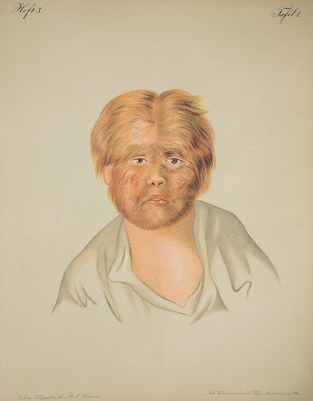 Hairy-faced boy. Image of a lithograph from Hebra's Atlas, pt. 10, pl. 8, showing a boy whose face is completely covered in…