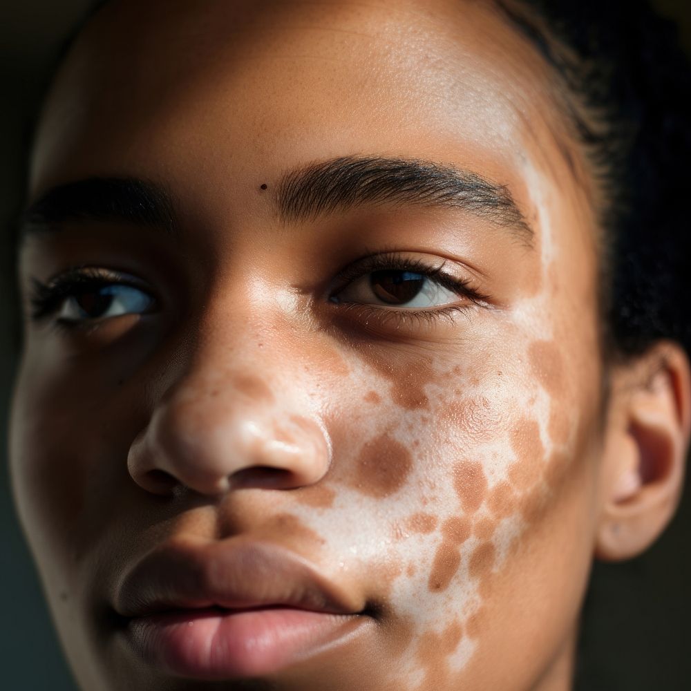 Woman's face with vitiligo skin, closeup. AI generated Image by rawpixel.