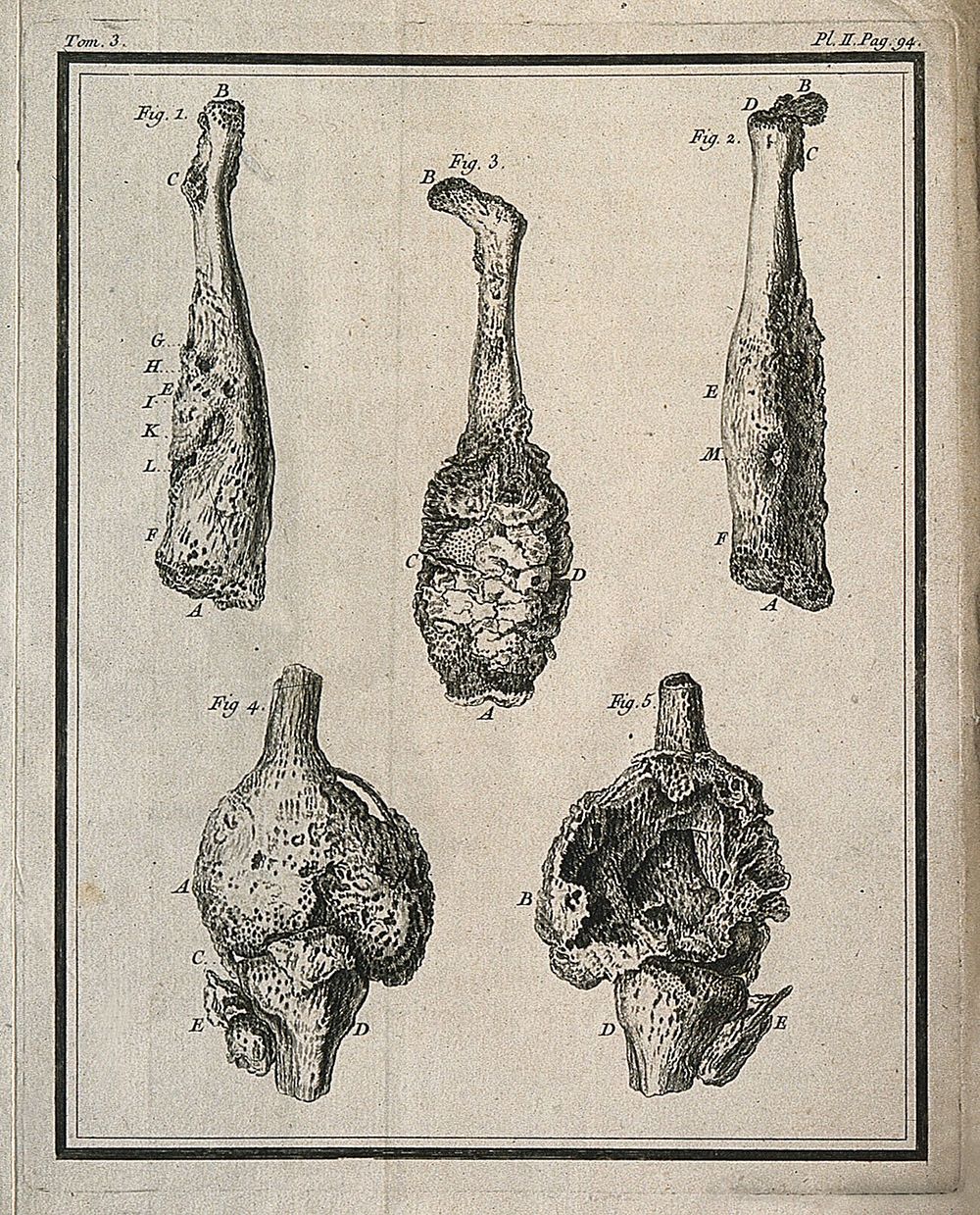 Five figures of exostoses (tumours) on the left femur (thigh-bone) Engraving, 1749.