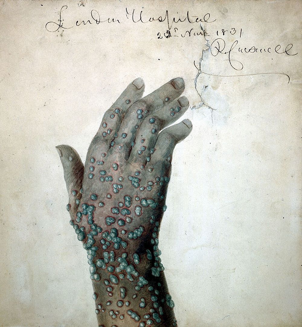 Rash of pustules on the hand of a patient, probably suffering from smallpox. Watercolour by R. Carswell, 1831.