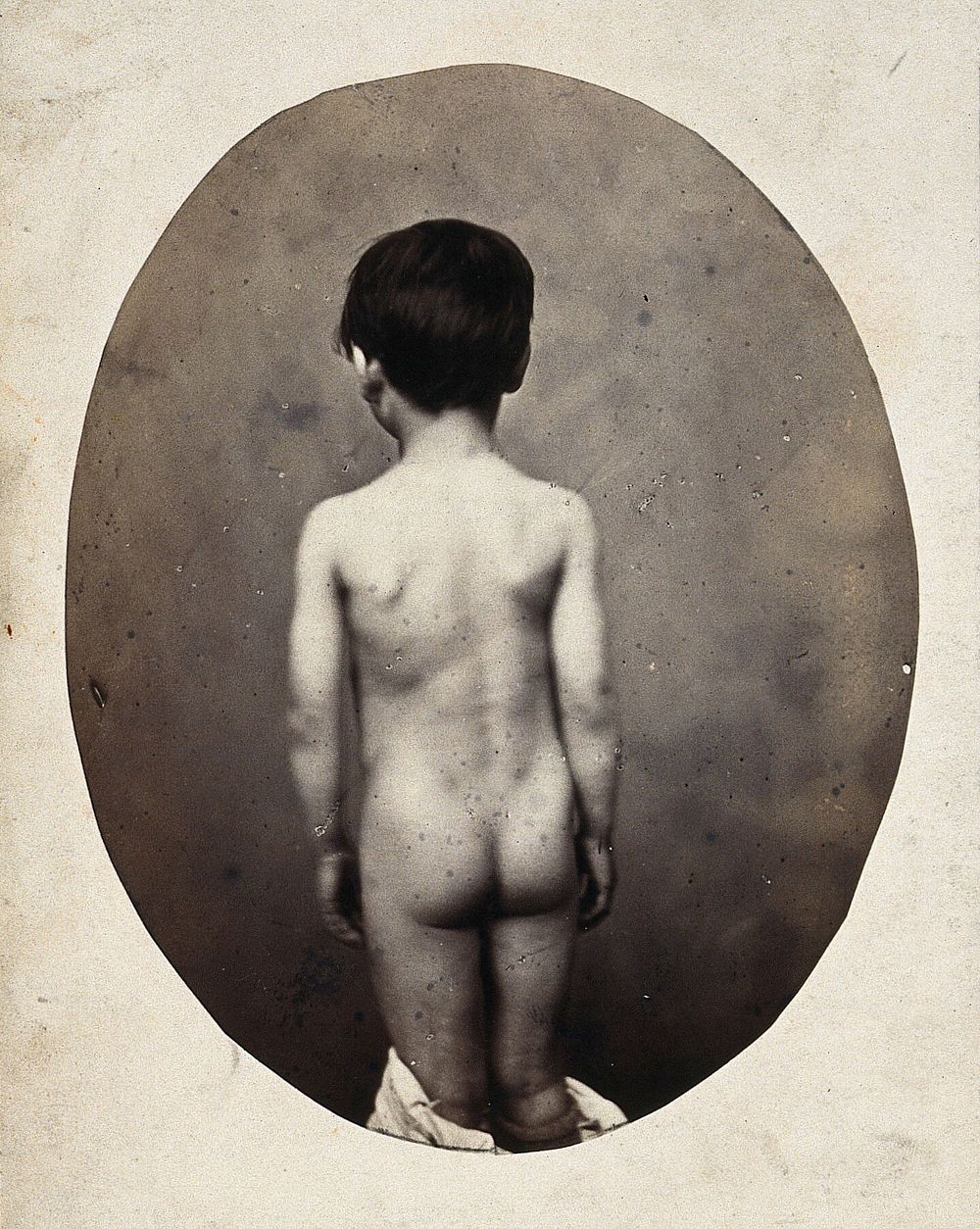 A standing child, naked, viewed from behind; his shoulders are uneven. Photograph by L. Haase after H.W. Berend, c. 1865.