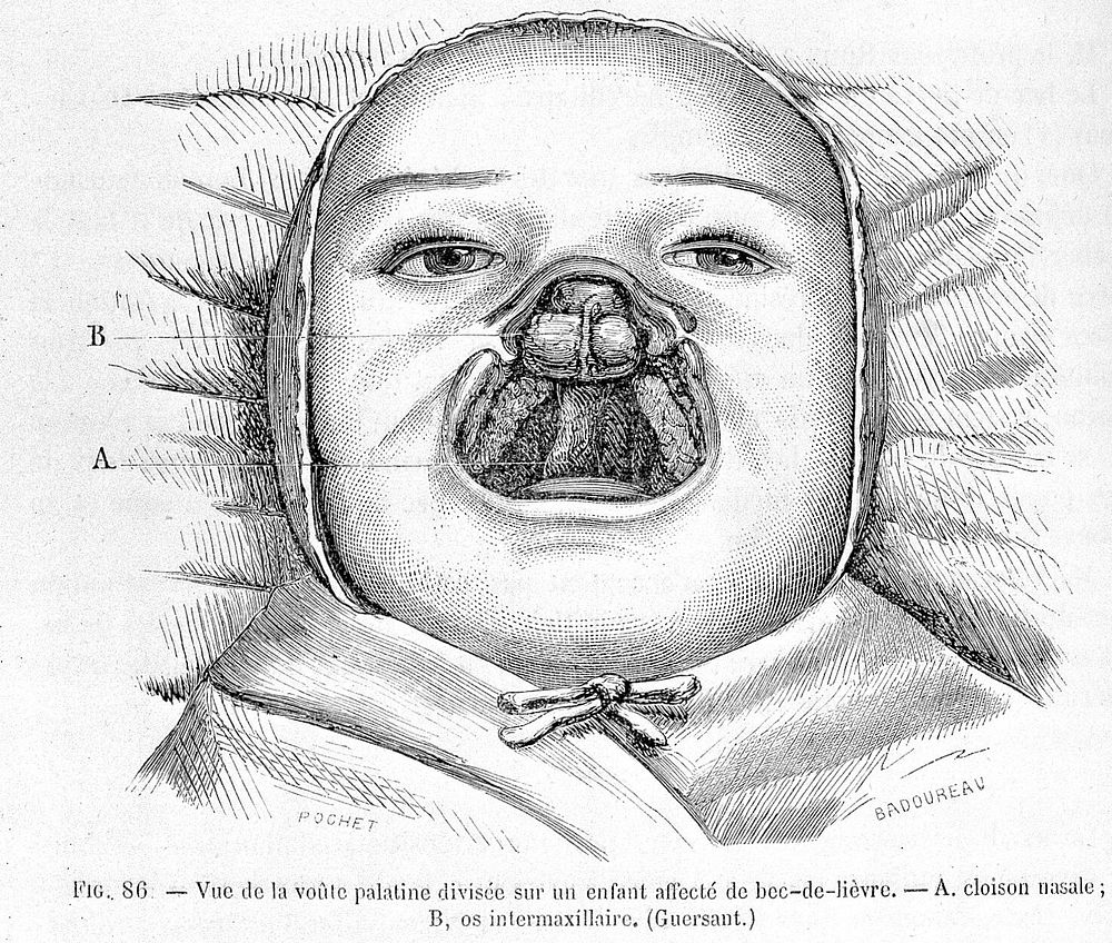 Infant with cleft palate and cleft lip. 19th Century.