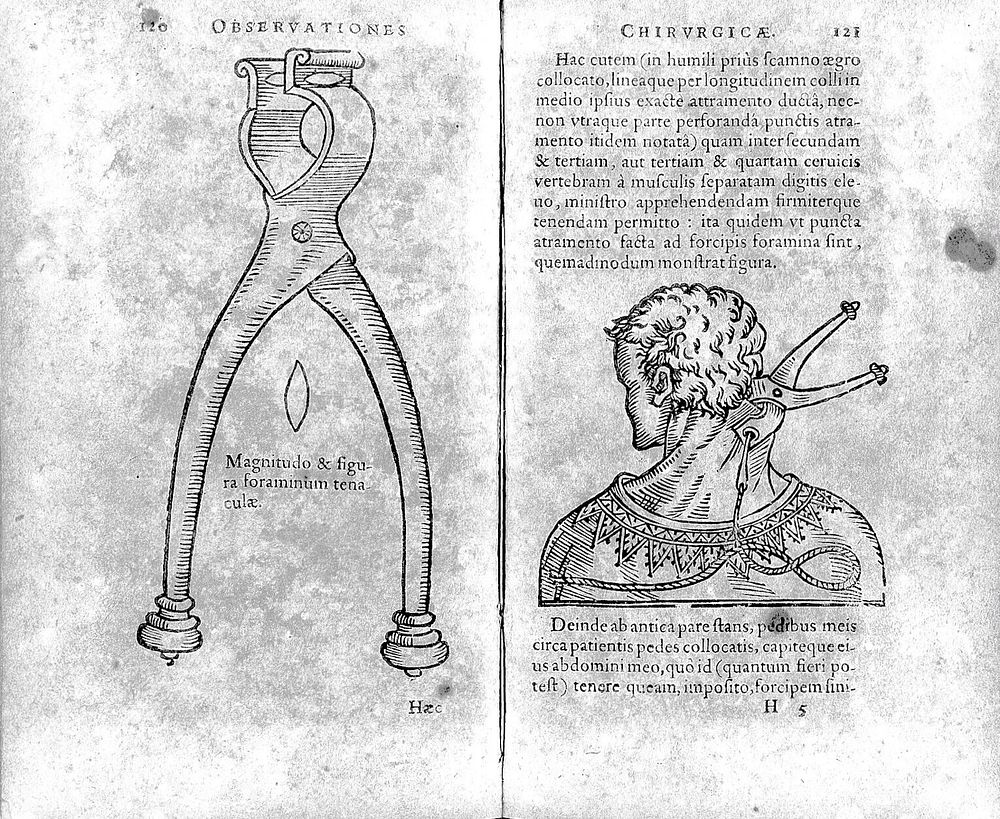 Guilielmi Fabricii Hildani ... Observationum et curationum chirurgicarum centuriæ. In qua inclusæ sunt viginti et quinque…