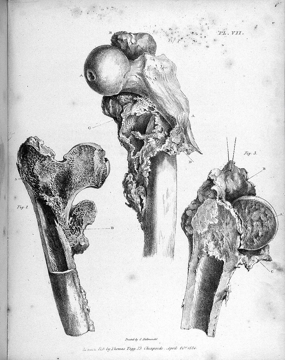 Observations on injuries of the spine and of the thigh bone: in two lectures. Delivered in the school of Great Windmill…