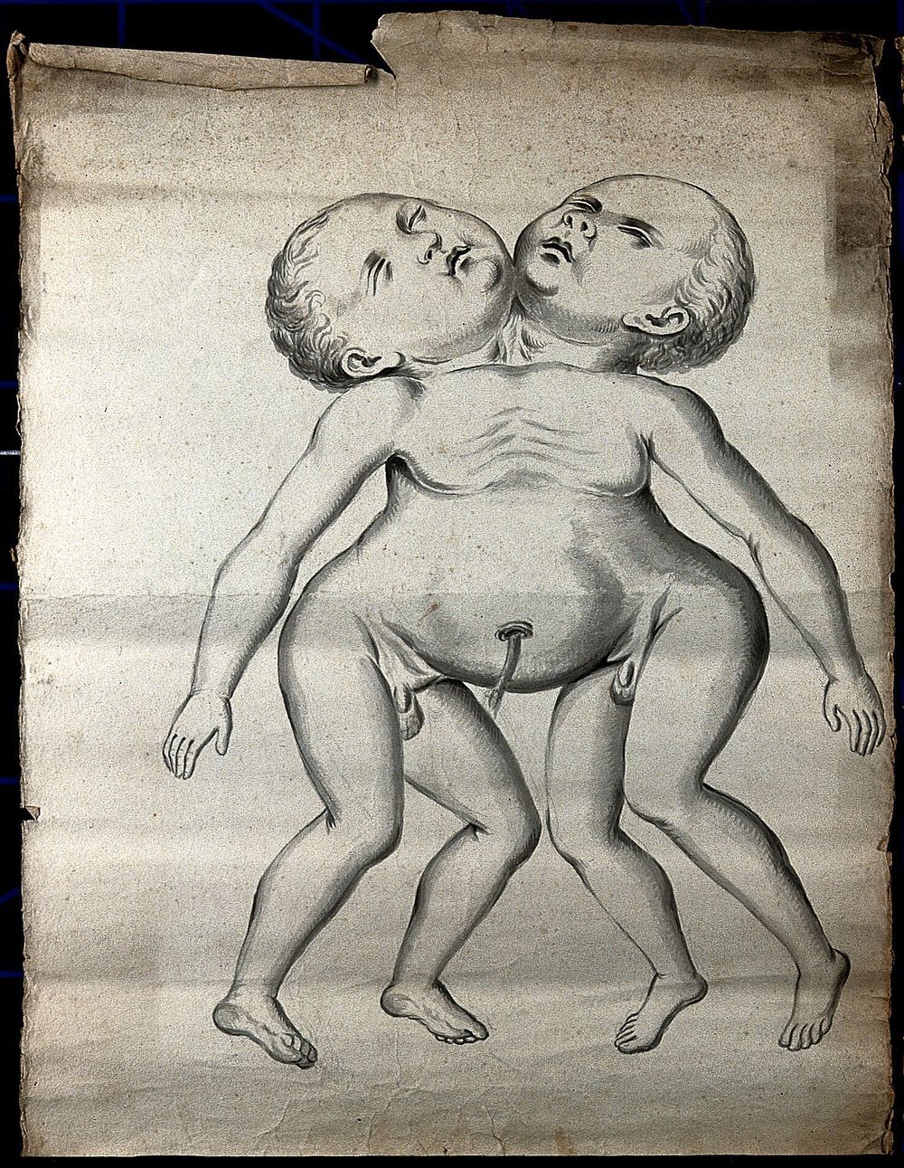 Male conjoint twins joint at the neck and chest; anterior view. Drawing, ca. 1900.