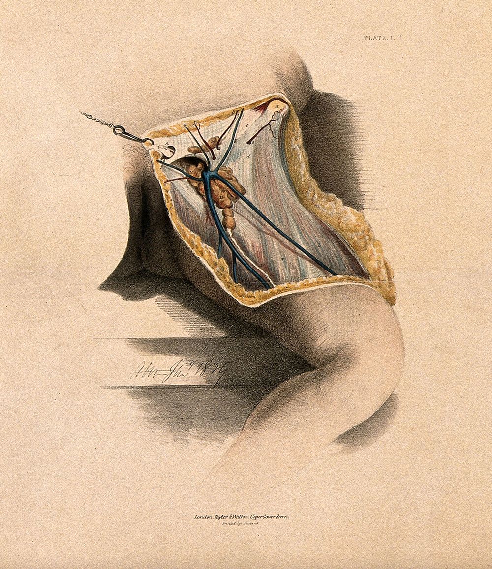 A dissection of the groin, showing the fascia, blood-vessels and lymphatic vessels. Coloured lithograph by A. Morton, 1839.