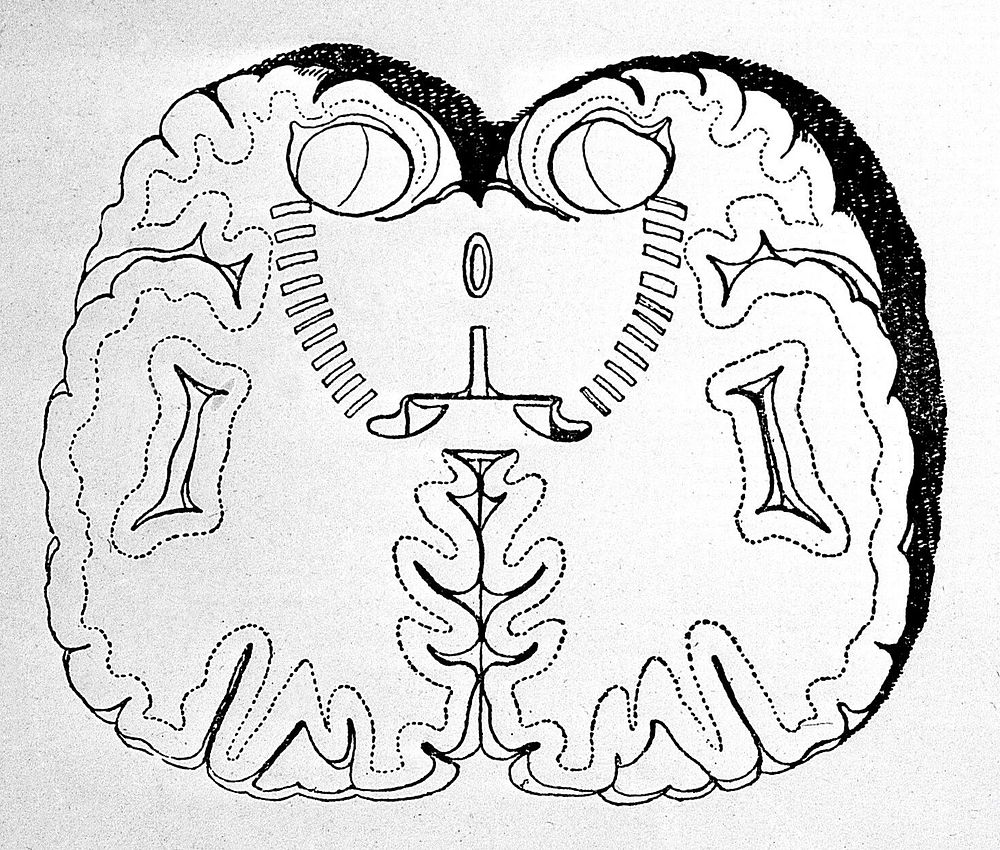 Plate showing coronal section of brain.