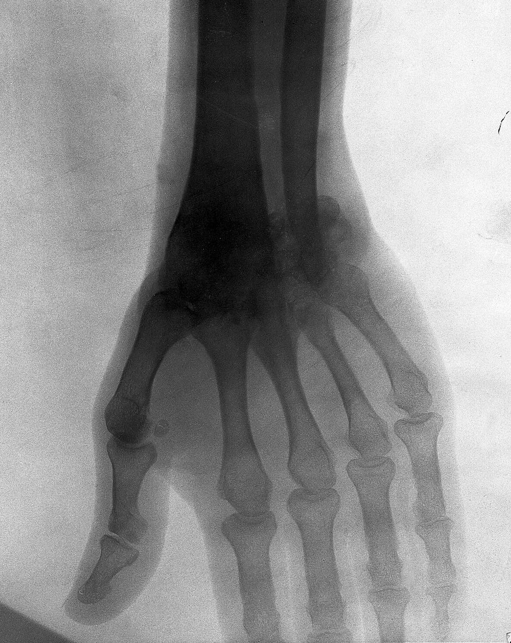 Bones of the hand of Sergeant Mather, possibly of 2nd Middlesex Regiment, showing tuberculous disease of the wrist.…