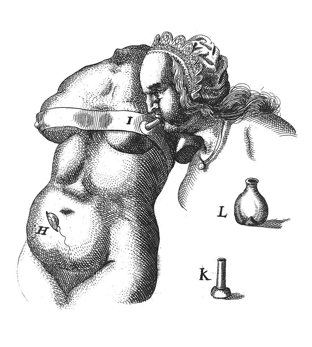 J. Scultetus "Armamentarium...", 1655, figure