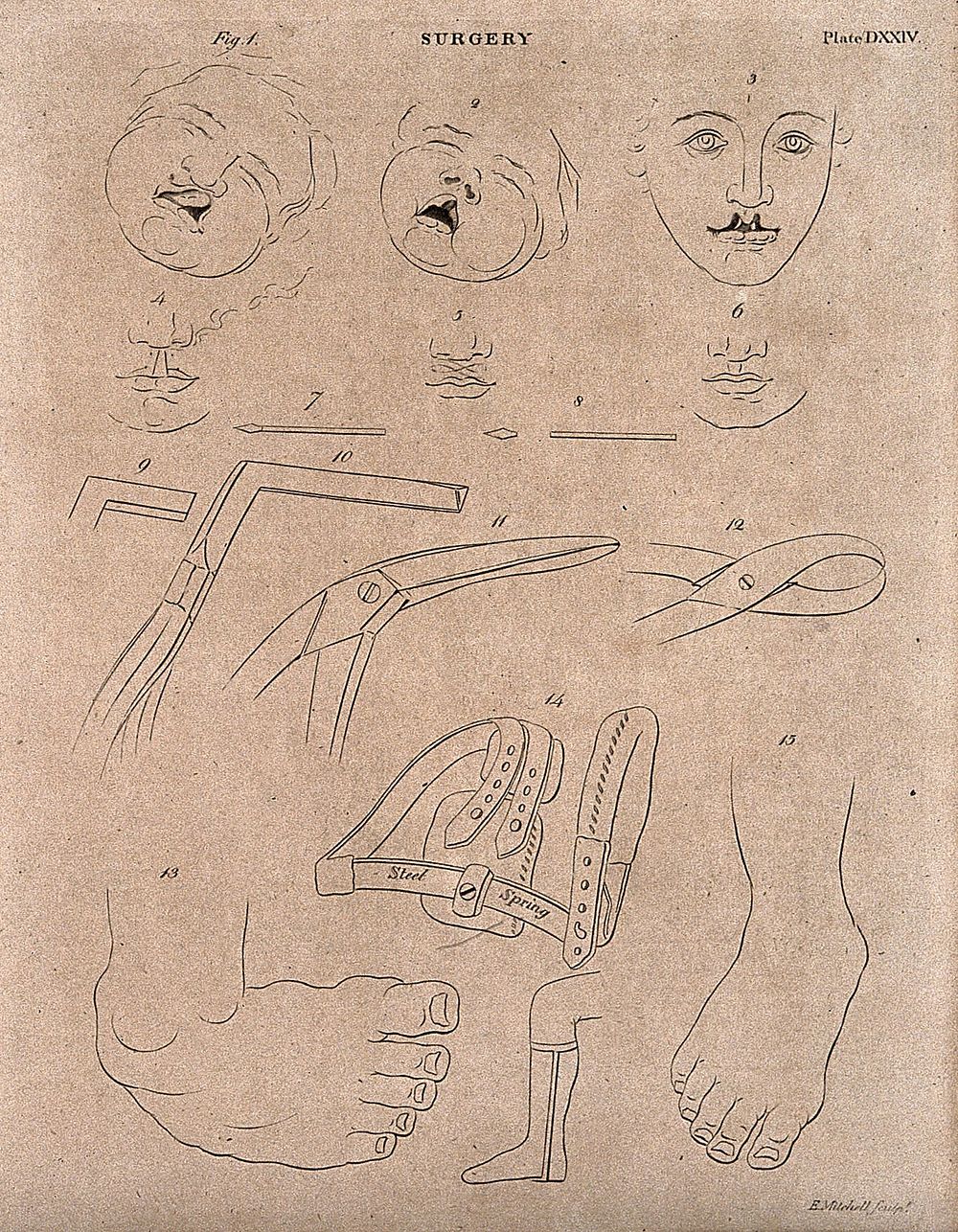Surgical instruments to correct cleft lip. Engraving by E. Mitchell.
