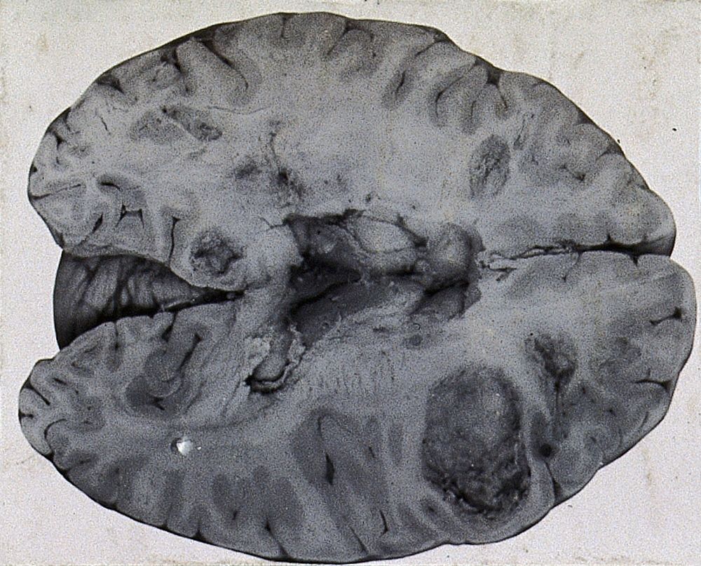 Friern Hospital, London: a brain