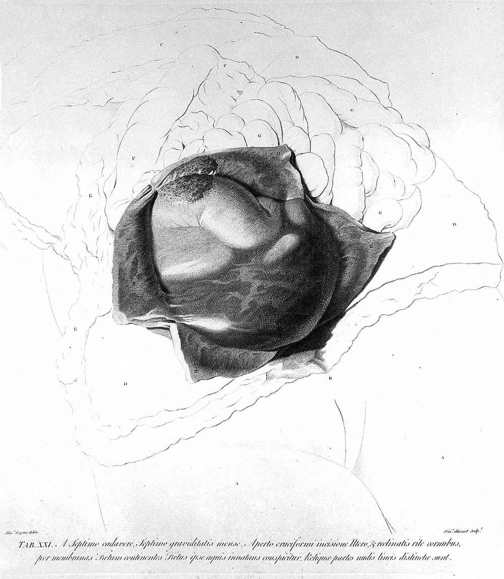 Anatomia uteri humani gravidi tabulis illustrata ... The anatomy of the human gravid uteris exhibited in figures / [William…