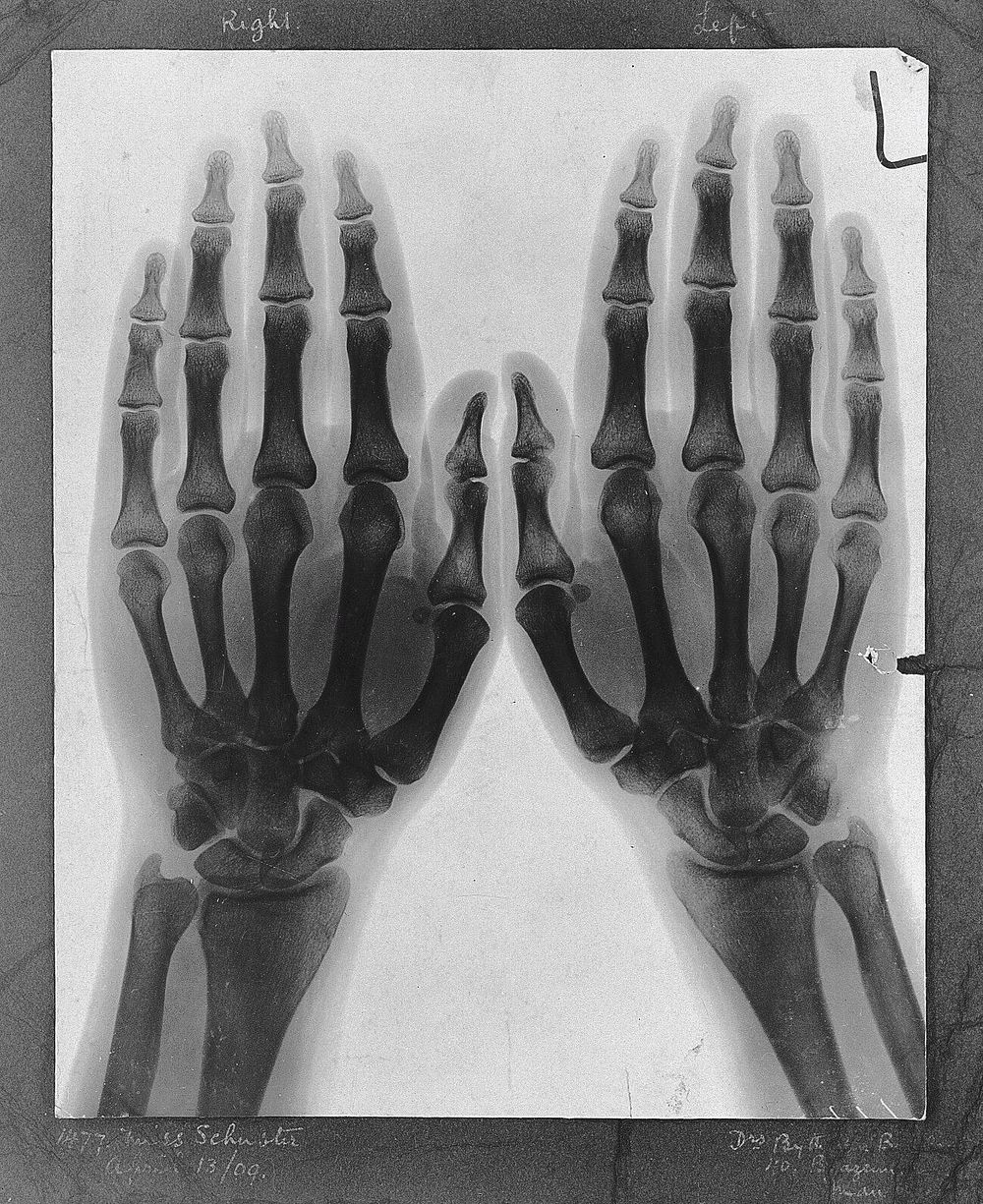 Two hands, viewed through x-ray. Photoprint from radiograph after Sir Arthur Schuster, 1896.