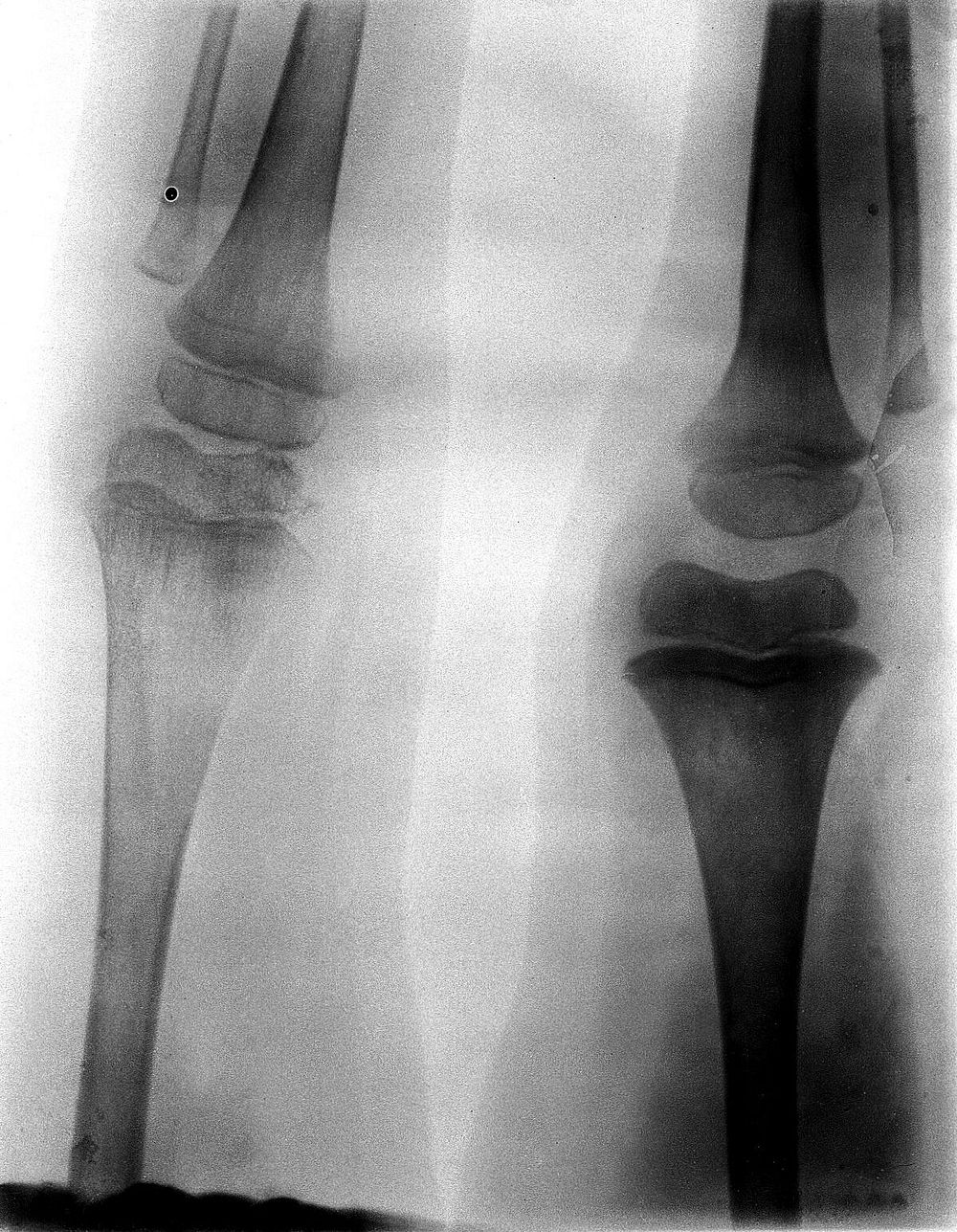 The left and right knee-joints of Frank Burgess, probably a soldier in the South African War, after excision of the left…