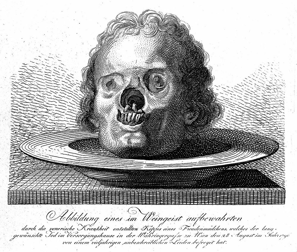 A preserved skull of a woman who had been suffering from syphilis, died in 1796. Line engraving.