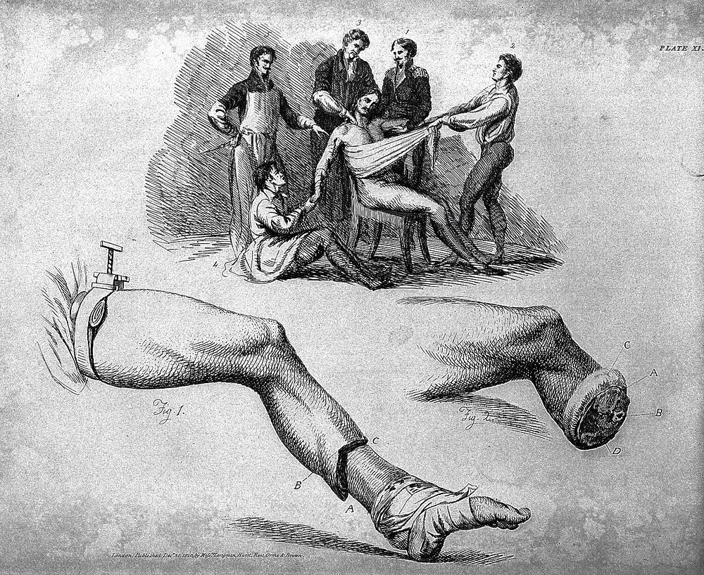 Illustrations of the great operations of surgery, trepan, hernia, amputation, aneurism, and lithotomy / [Sir Charles Bell].