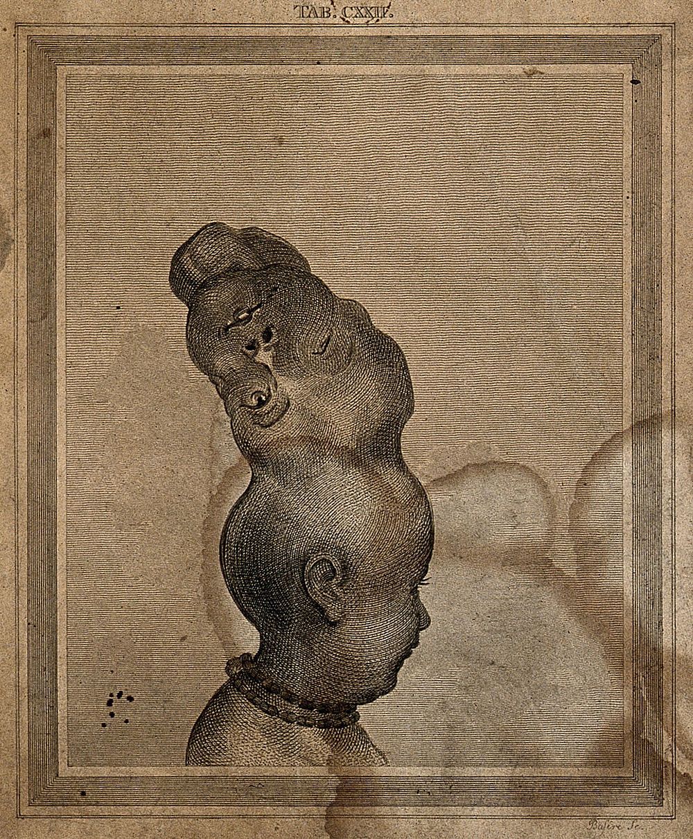 A child with two skulls joined together at the vertex, seen from the right. Engraving by J. Basire.