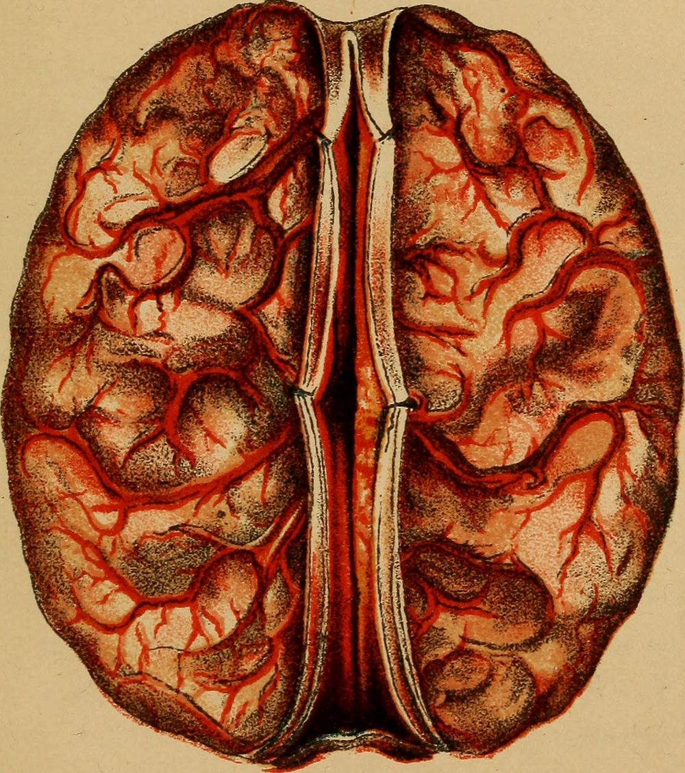 Effects of Alcohol upon the brain of a boy seventeen years of age. The whole organ and its membranes and vessels were…