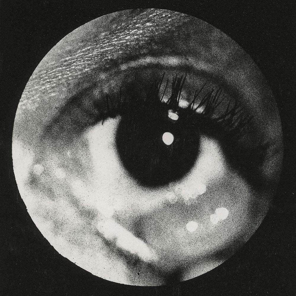 Clinical photograph of a cyst of conjunctiva. Original image from National Museum of Health and Medicine. Digitally enhanced…