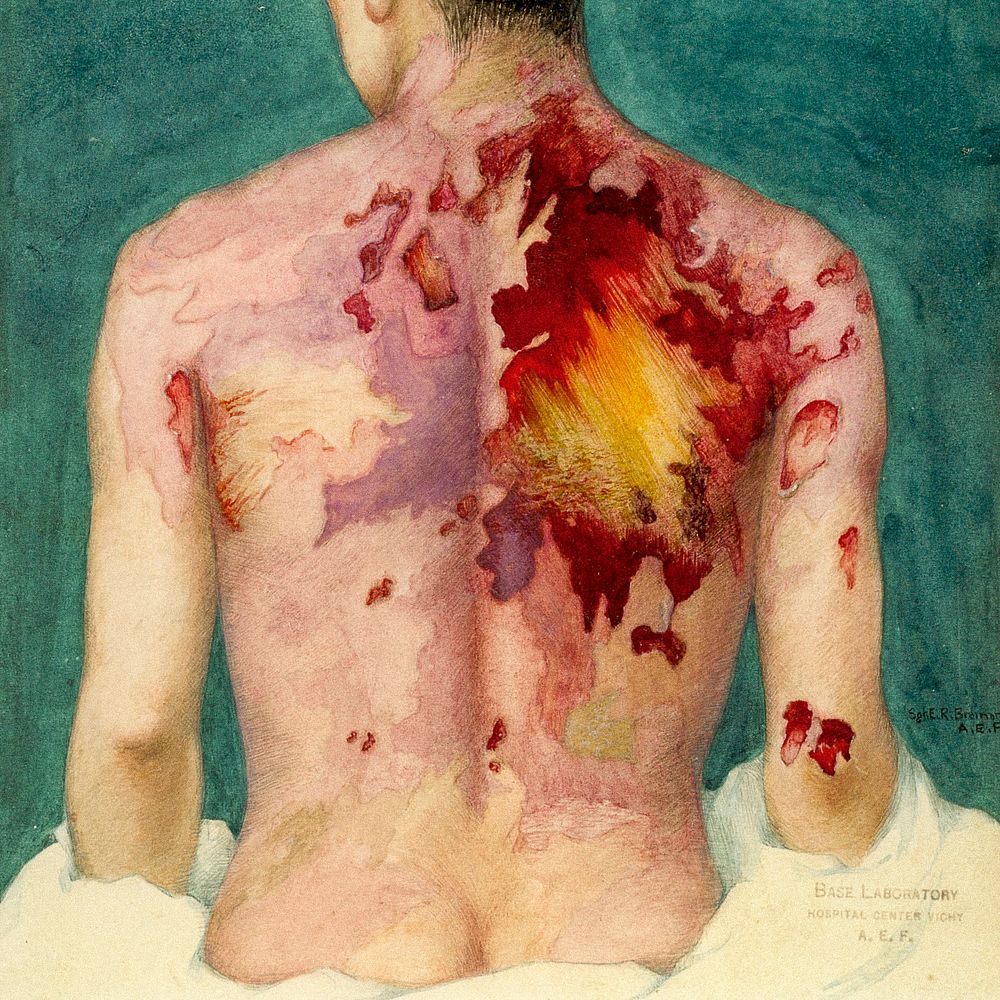 Watercolor painting of mustard gas burns (1918) by Sgt. E.R. Brainard. Original image from National Museum of Health and…