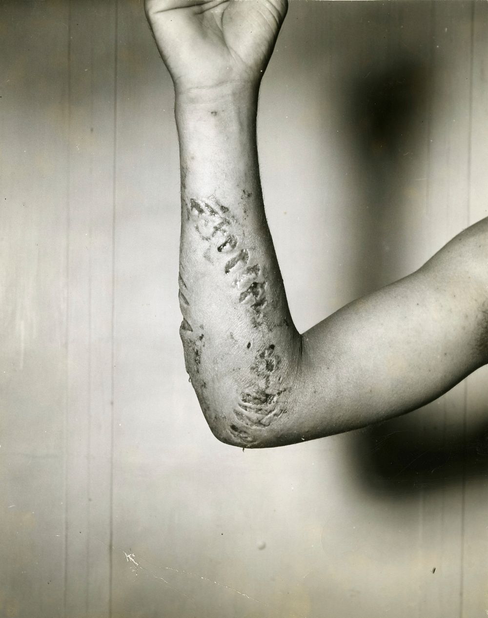 U.S.S. Solace AH5. Survivor report of 01/04/1945 to Bureau of Medicine and Surgery. Shark Bite- arm. Patient - Nagurney, N.…