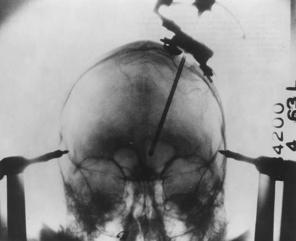 X-ray photograph of a brain tumor probe. Original public domain image from Flickr