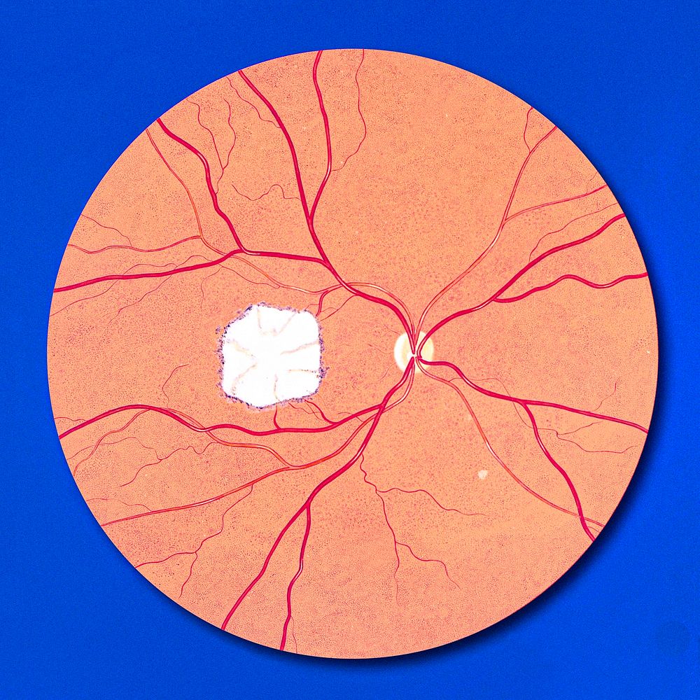 Fundoscopic view of the right eye, it's optic nerve and blood vessels supplying the retina.