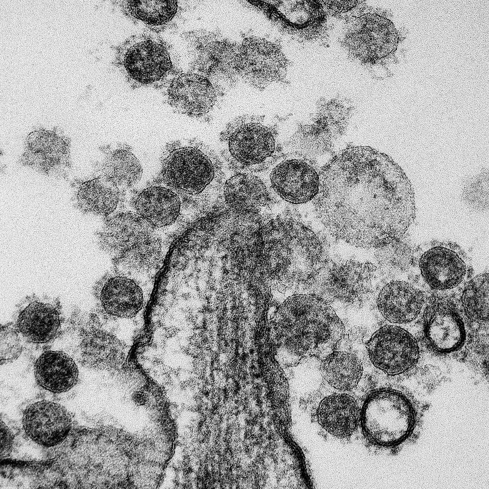 MERS Coronavirus Particles&ndash;Transmission electron micrograph of Middle East Respiratory Syndrome CoV particles found…
