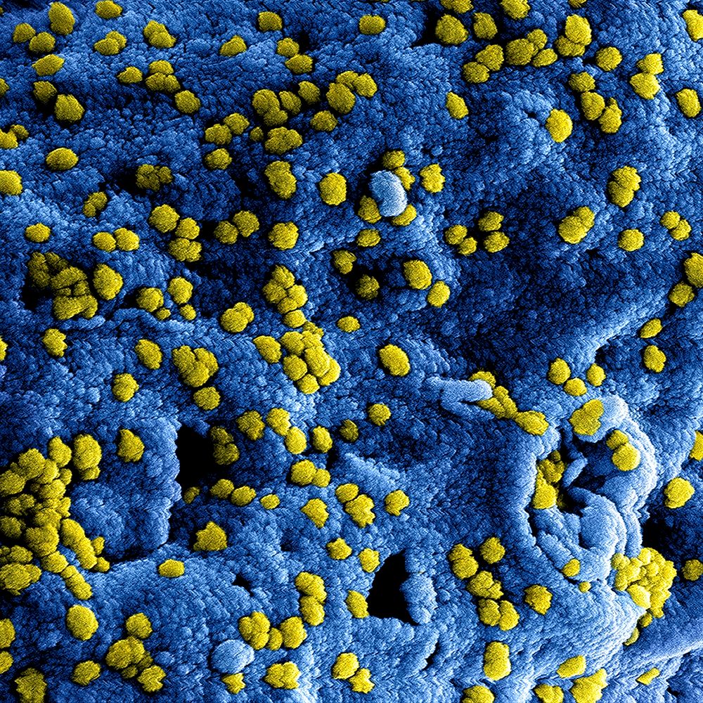 MERS Coronavirus Particles&ndash;Colorized scanning electron micrograph of Middle East Respiratory Syndrome virus particles…