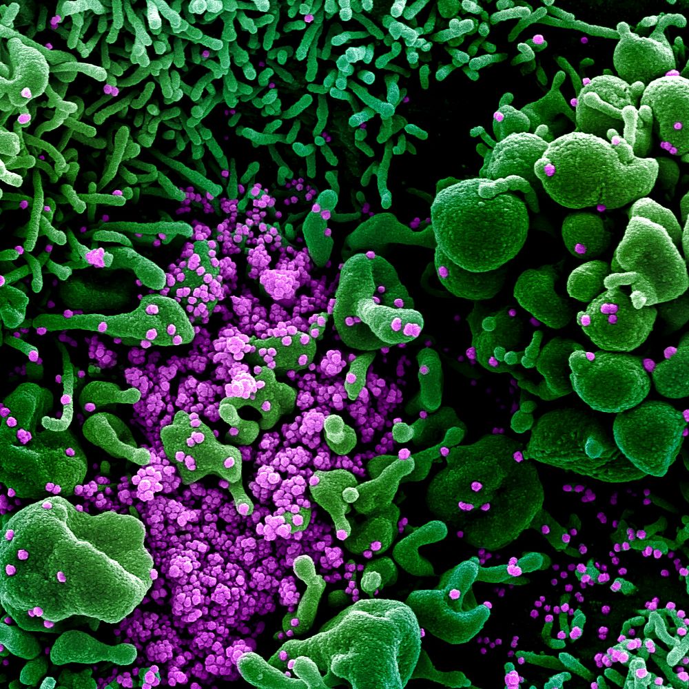Novel Coronavirus SARS-CoV-2&ndash;Colorized scanning electron micrograph of an apoptotic cell (green) heavily infected with…