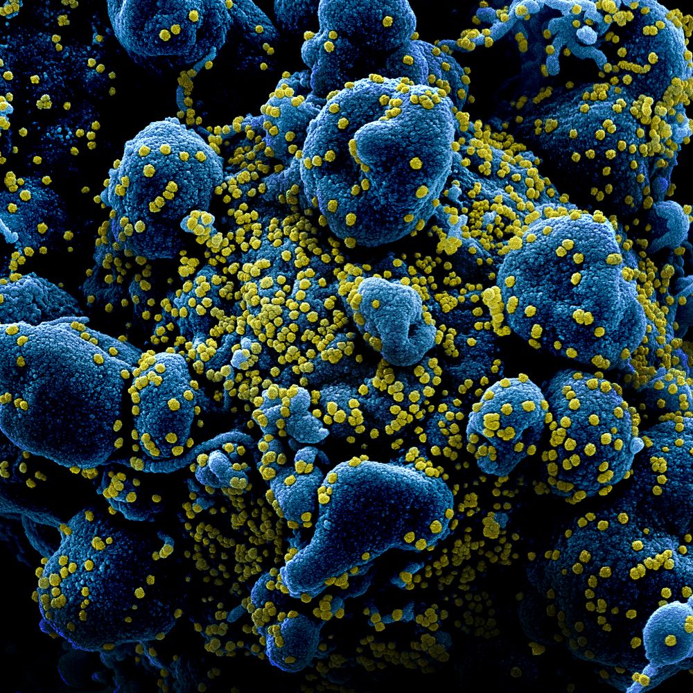 Novel Coronavirus SARS-CoV-2&ndash;Colorized scanning electron micrograph of an apoptotic cell (blue) heavily infected with…