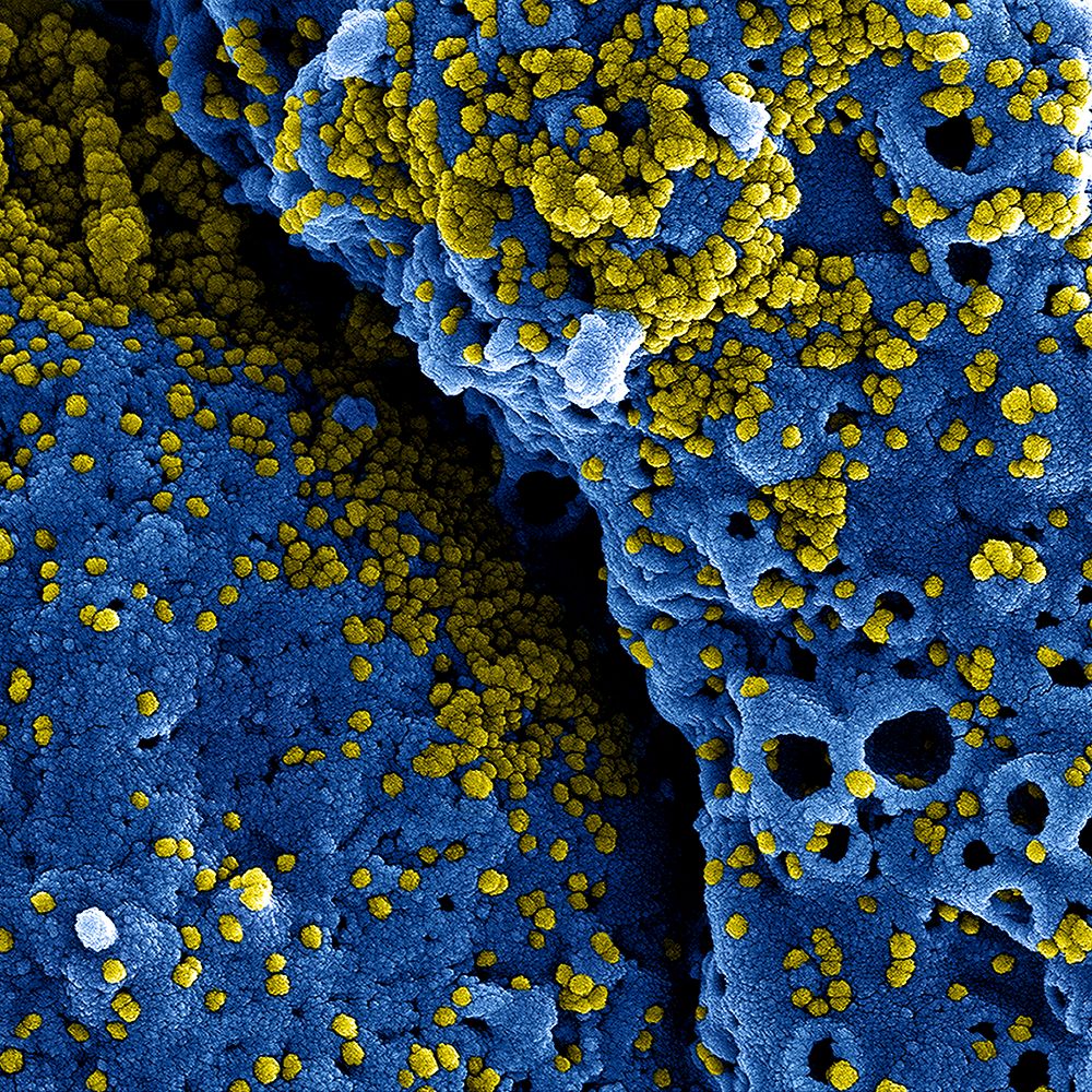 MERS Coronavirus Particles&ndash;Colorized scanning electron micrograph of MERS virus particles (yellow) both budding and…